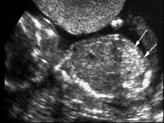 <p>all describes <strong>echogenic bowe</strong>l <strong>except</strong></p><p>a) can be a normal variant</p><p>b) echogenic bowel causes posterior shadowing</p><p>c) bowel is increased in echogenicity similar to bone</p><p>d) unable to dx until late 2nd trimester</p>
