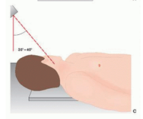 <ul><li><p>PILLAR VIEW</p></li><li><p>CENTER OF THE NECK AT THE THYROID CARTILAGE REGION, 30-45 DEG CAUDAL </p></li></ul>