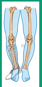 <p>Excessive pressure on the lateral surface of the foot </p>