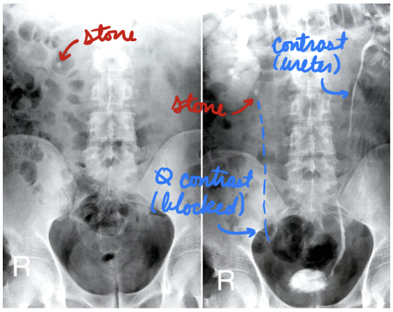<p>Intravenous pylogram (IVP)</p><ul><li><p>X-ray + contrast</p></li></ul><p>Rare → Use CT instead</p><p></p>