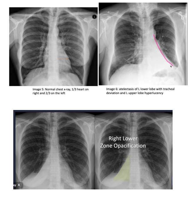 <ul><li><p>chest Xray: colume loss, shift of fissuresm elebated hemidiaphram</p></li><li><p>ct when unclear: consider risk factors </p></li></ul><p></p>