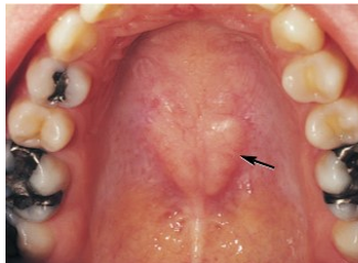 <ul><li><p>variation noted in the midline of the hard palate</p></li><li><p>developmental growths of bone with a hereditary etiology</p></li><li><p>vary in size, slow growing, asymptomatic, may be seen on radiographs</p></li></ul><p></p>