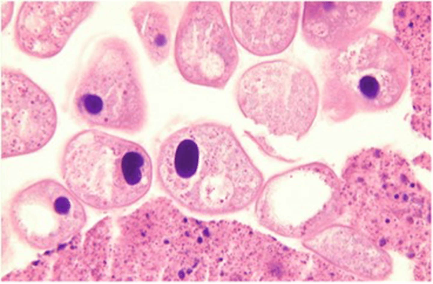 <p>This protozoan, ciliate trophozoite form is found in the large intestine of swine but can also</p><p>be seen in dogs. It can cause diarrhea but is generally considered nonpathogenic.</p>