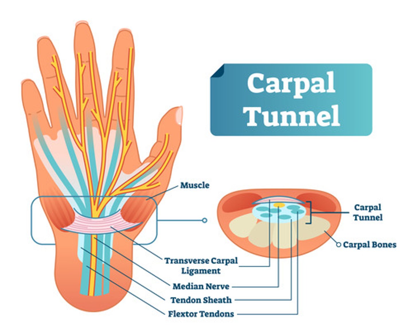 <p>occurs when the median nerve, which runs from the forearm into the palm of the hand, becomes constricted. The carpal tunnel is a narrow passageway of the ligaments and bones at the base of the hand that houses the median nerves and the tendons that bend the fingers. The median nerve provides feeling to the palm side of the thumb and to the index, middle, and ring fingers but not to the little finger. A common cause of CTS is repetitive activity with the hands that cause irritated tendons, causing compression of the median nerve.</p>