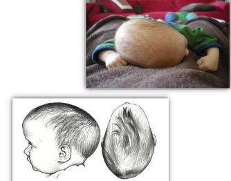 <p>Disproportionate - Length </p><ul><li><p>increased cranial length </p></li><li><p>decreased cranial width </p></li><li><p>occipital protuberance</p></li><li><p>frontal protuberance/bossing</p></li><li><p>asymmetry may be present </p></li><li><p>least common infant skull deformation </p></li></ul><p></p>