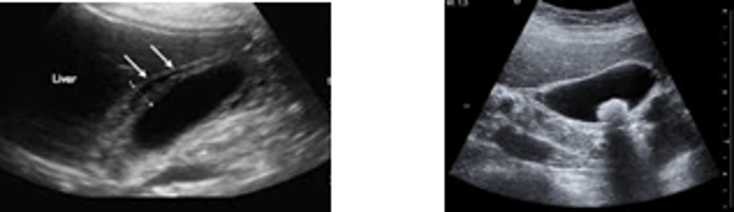<p>Wall thickening, edema, gallstones, pericholecystic fluid (highly sensitive and specific)</p>