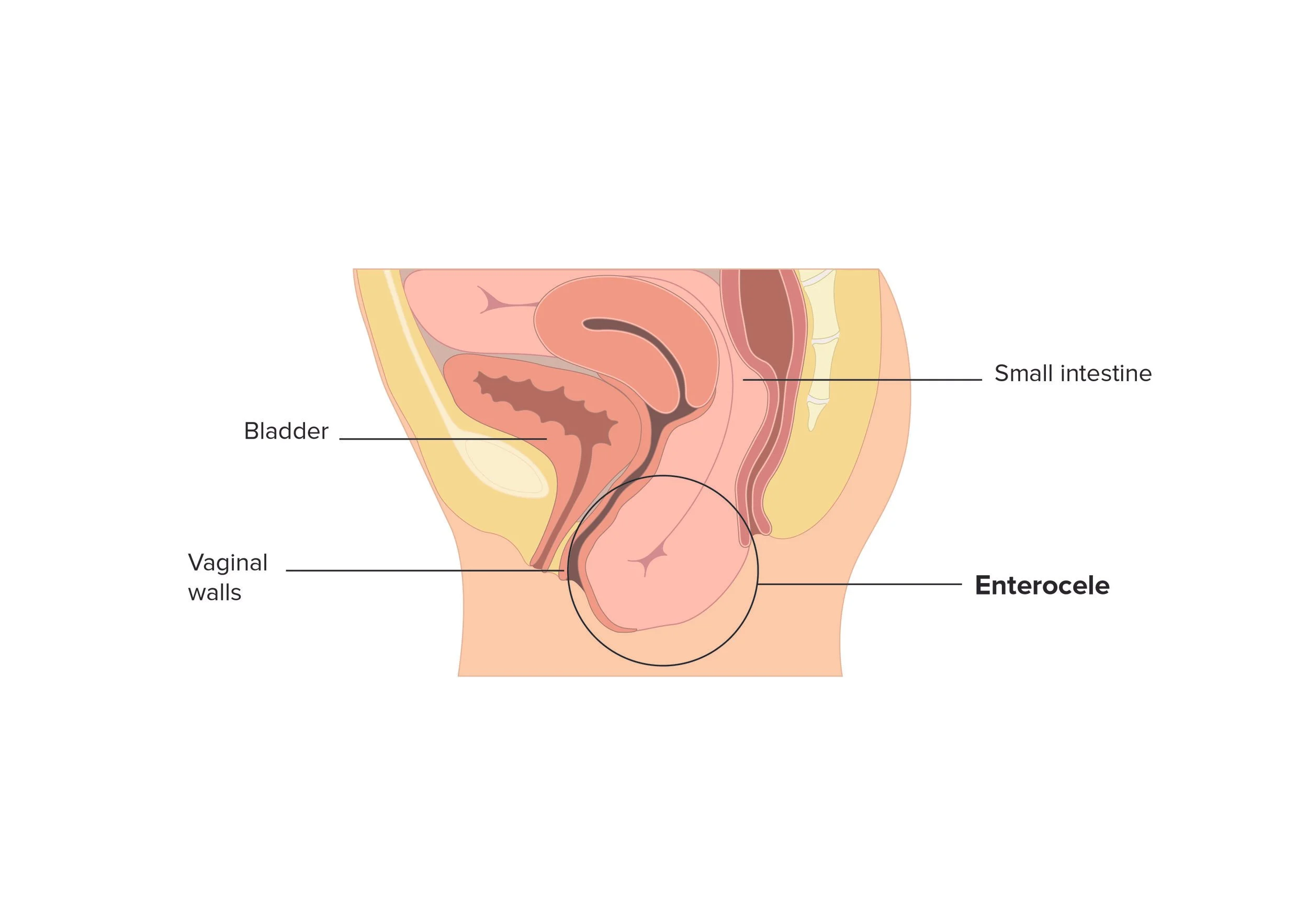 <ul><li><p>prolapse of upper posterior vaginal wall btwn vagina &amp; rectum</p></li><li><p>often contains loop of bowel</p></li></ul><p></p>