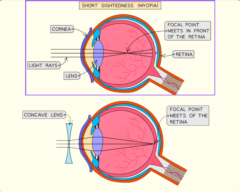 <p>It is caused by:</p><p>the eyeball being elongated - so that the distance between the lens and the retina is too great</p><p>the lens being too thick and curved - so that light is focused in front of the retina</p><p>It can be corrected by concave lens-&gt;</p>