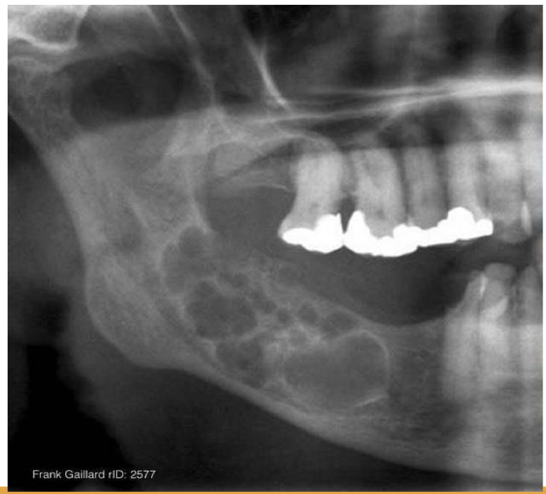 <p>A 25 year old patient present with mild swelling of lower jaw. Intra orally a small swelling was visible over right third molar region. A radiograph taken. Provide Differential diagnosis and justify</p>