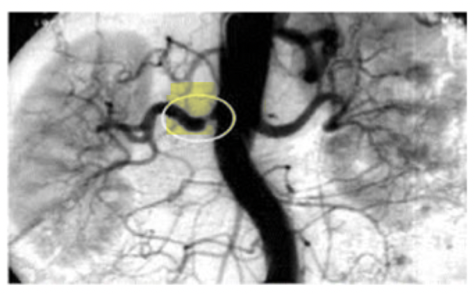 <p>_______________ usually forms at the beginning of the renal artery where it branches from the aorta</p>