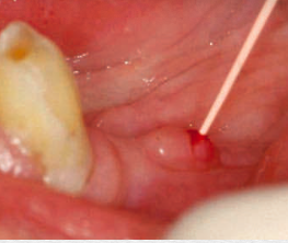 <p><strong>aka: </strong>gumboil</p><p><span>a </span><span style="color: red;"><span>small abscess</span></span><span> on the gingiva, originating from an </span><span style="color: red;"><span>apical or periodontal abscess</span></span></p><ul><li><p><strong>treatment:</strong></p><ul><li><p>will resolve if the<span style="color: red;"> source of infection is eliminated</span></p></li></ul></li></ul><p></p>