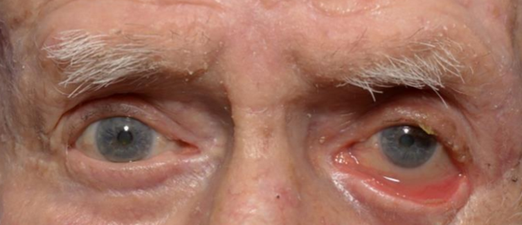 <p>What eyelid position condition is this?</p>