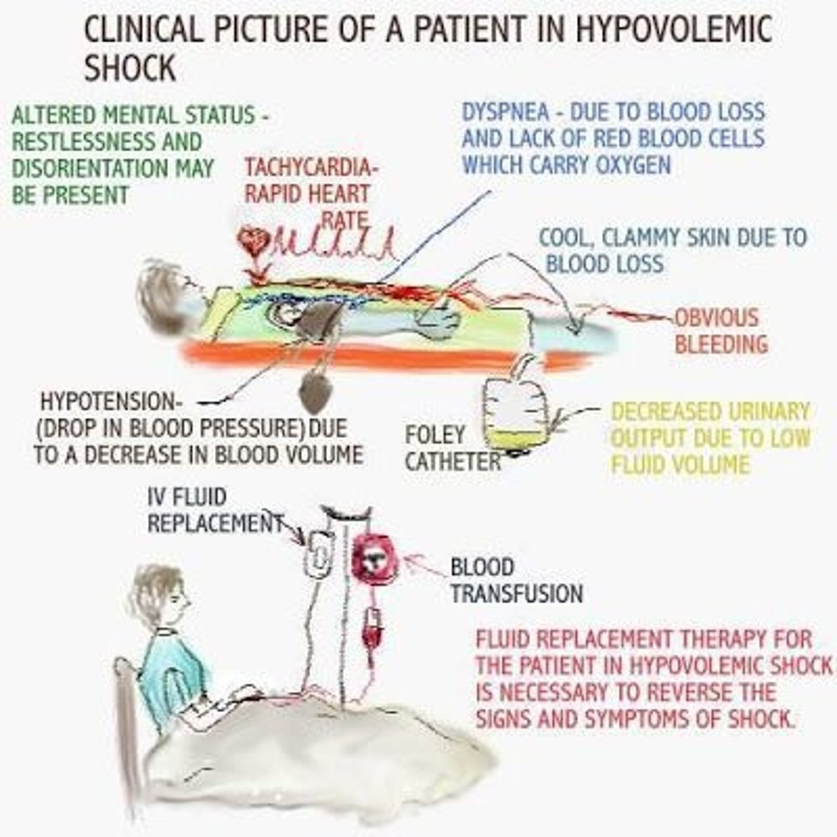 <p>Dehydration, pulse and respirations are increased; BP may decline. Restlessness, anxiety and confusion may all be present.</p><p>Caused by hemorrhage, vomiting, diarrhea</p><p>OCCURS IN: Addison's disease, burns, pancreatitis, peritonitis</p>