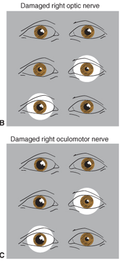 <p>with a damaged optic nerve: the eye constricts when light is shone in the other eye, but not when the light is shone in the affected eye. </p><p>with a damaged oculomotor nerve: the eye does not constrict</p>