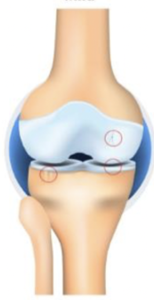 <p>Which stage of OA is characterized by definite osteophytes and possible JSN</p>