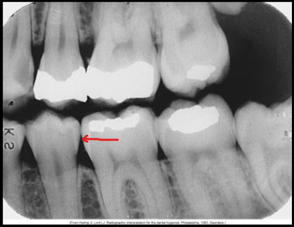 <p>What class of interproximal caries is this?</p>