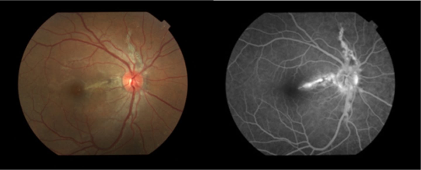 <p>educate on potential CNV or choroidal rupture, esp with injury = polycarbonate, reduced contact sports</p><p>Amsler for home monitoring</p><p>refer for CT disease workup if not already diagnosed</p>