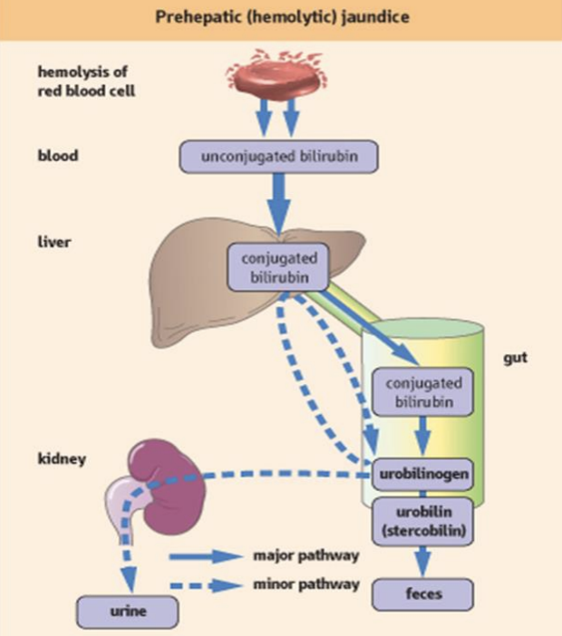 <p>A type of jaundice caused by excessive breakdown of red blood cells, leading to increased bilirubin production before it reaches the liver. This results in elevated unconjugated bilirubin levels in the blood. </p>