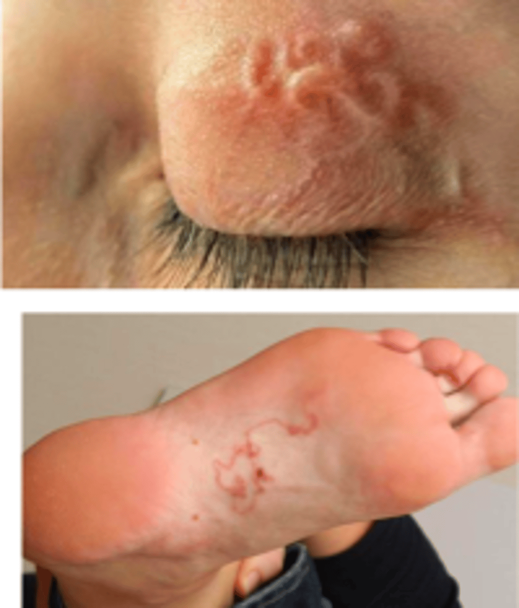 <p>Skin penetration by infective L3 Larvae.</p><p>All hookworms may implicated in CLM</p>