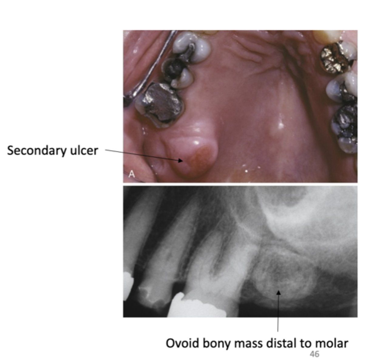 <p>What do palatal exostoses develop from? </p>