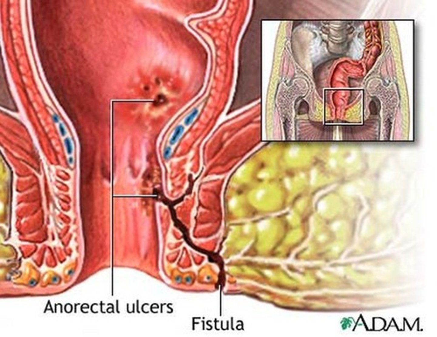 <p>fistulas (perianal, enterocutaneous, enteroenteric, enterovesicular, enterovaginal)</p><p>- lower risk of carcinoma than UC</p><p>- nutritional deficiencies</p><p>- extra-intestinal manifestations</p>