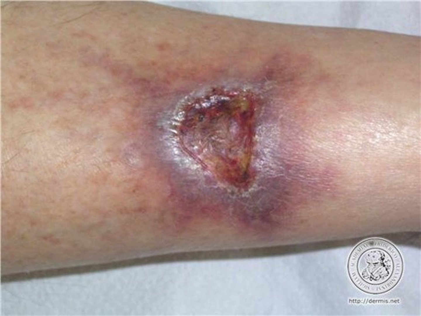 <p>necrotic ulcer (tissue necrosis due to proteolytic enzymes in venom)</p>
