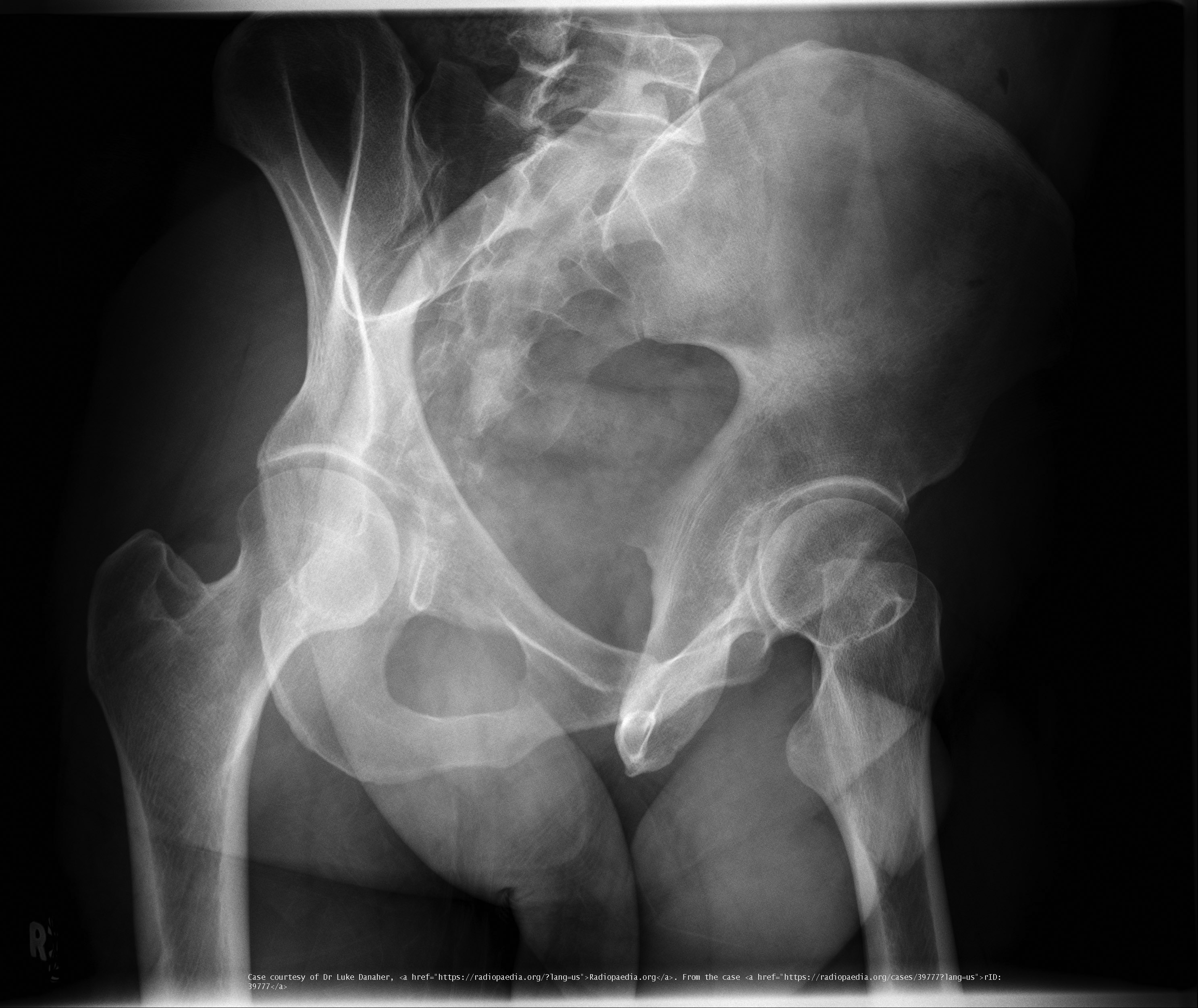 <p>Evaluation of acetabular fractures.</p>