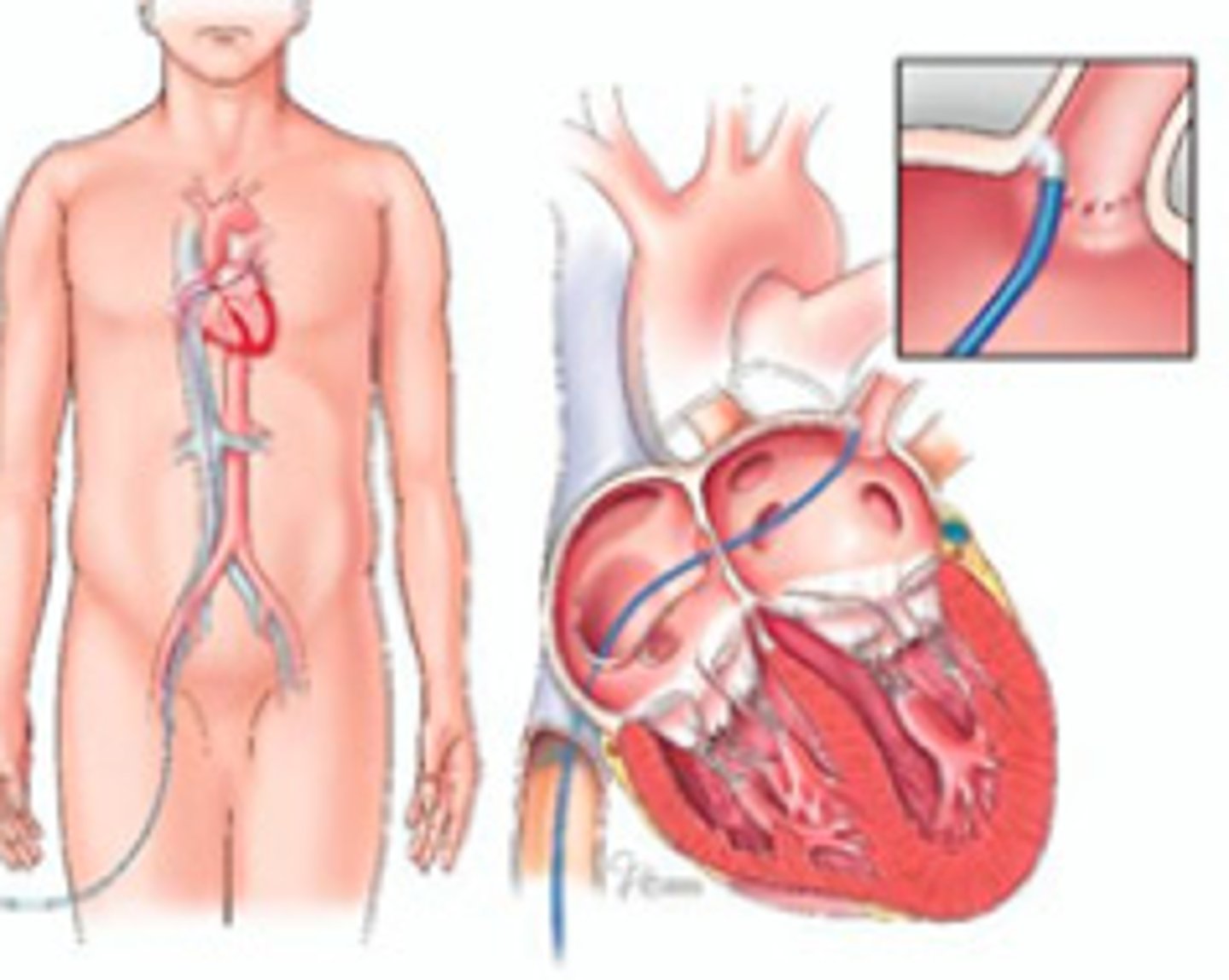 <p>procedure in which a catheter is inserted through a vein in the groin and threaded to the heart to correct structural problems in the heart that cause arrhythmia; employs radiofrequency (heat) laser or cryoenergy to cause scarring of abnormal areas</p>
