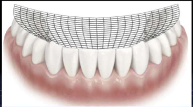 <p>three-dimensional curvature of the occlusal plane, which is a combination of the curve of spee and curve of wilson</p>