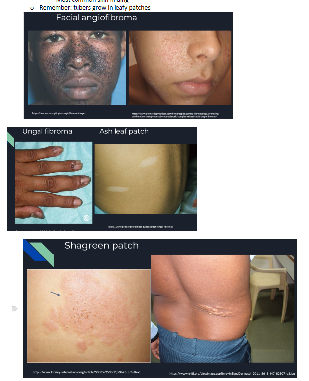 <p>B) Tuberous sclerosis </p>