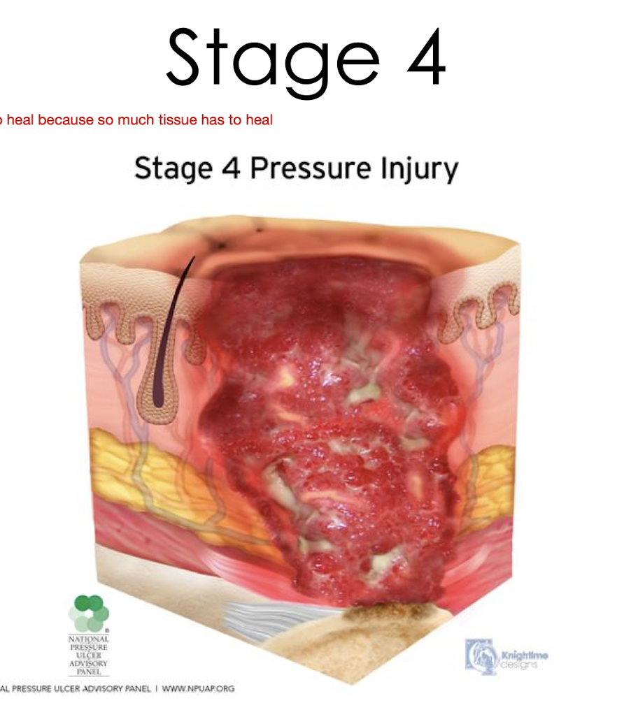 <p>Stage 4:</p><ul><li><p>What is it?</p></li><li><p>What is may be visible in their wound base?</p></li><li><p>What type of wound edges often occur?</p></li></ul><p></p><p></p>