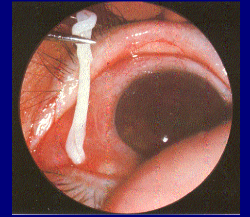 <p>Spirometra mansonoides, plerocercoid</p>