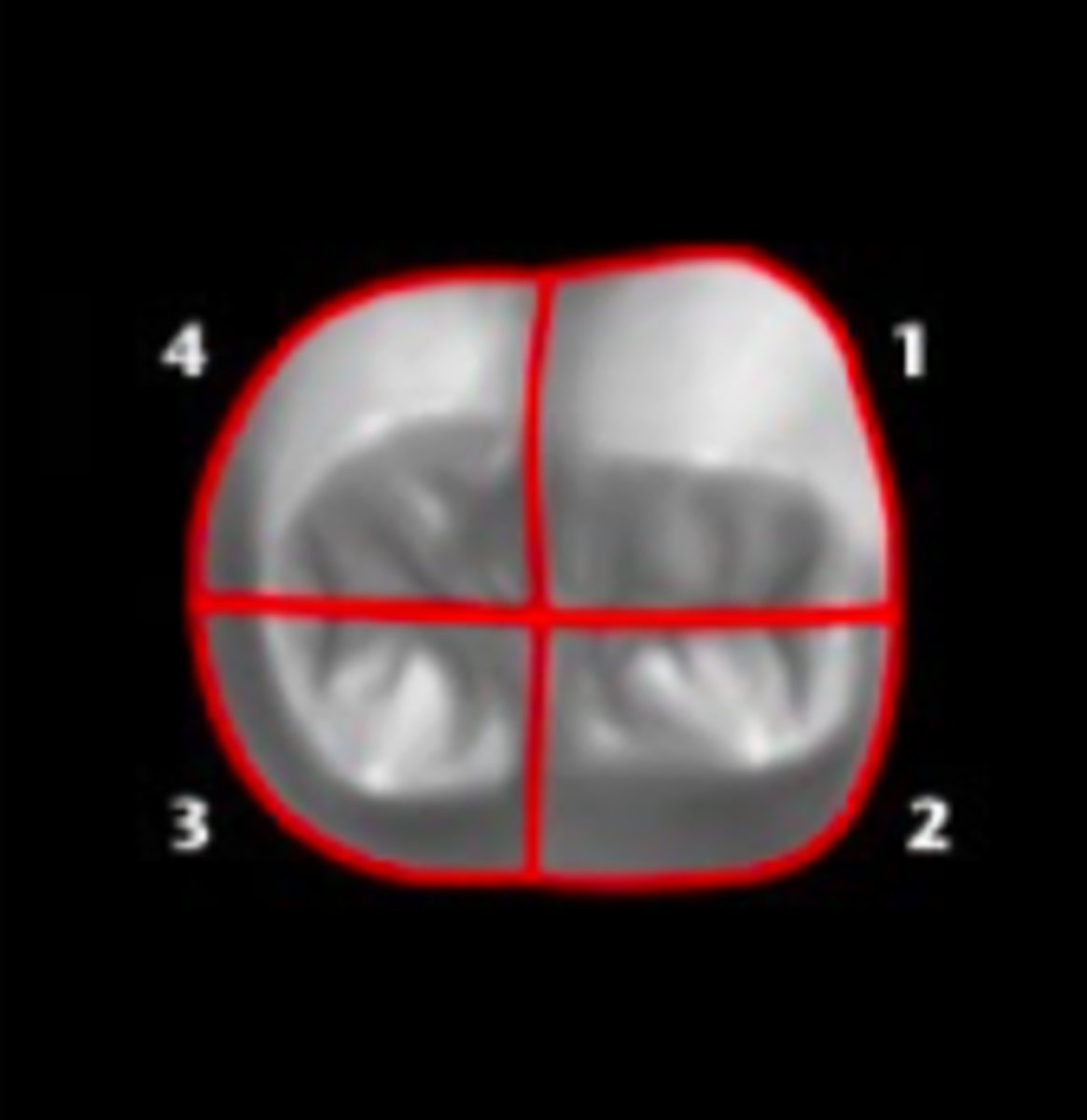 <p>1. mesiobuccal</p><p>2. distobuccal</p><p>3. mesiolingual</p><p>4. distolingual</p>