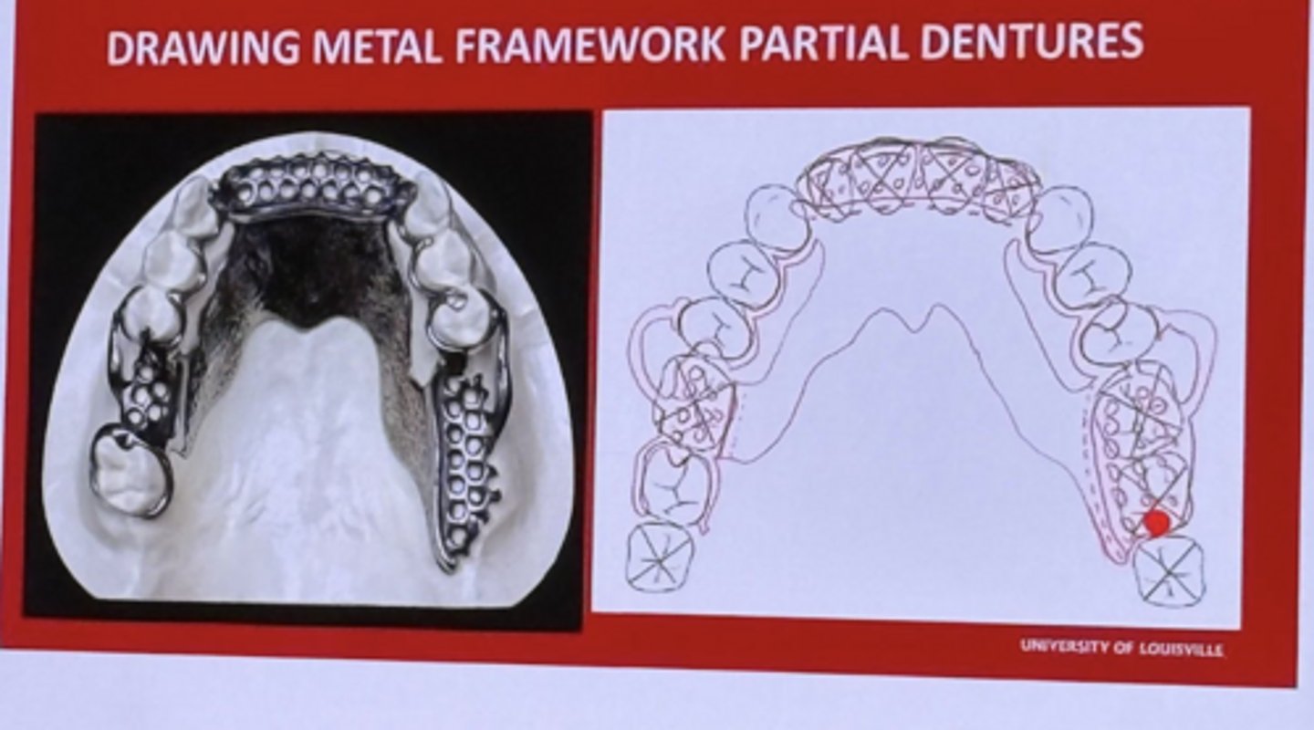 <p>-there are 3 guide plates used for POI correct</p><p>-there are 3 occlusal rests and 1 embrasure rest on five abutment teeth</p><p>-there in a cast metal minor connector connecting embrasure rest to major drawn correctly</p>