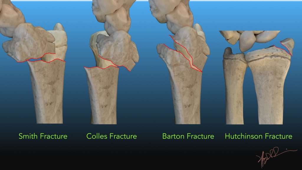 <p>flexion; extension; fracture at distal radius + dislocation at radio carpal joint; radial styloid process or intra articular fracture of styloid process </p>