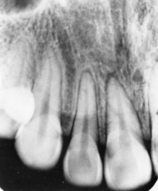 <p>dental injury from hard impact</p><ul><li><p>there may be no radiographic changes</p></li><li><p>tooth may have widened PDL space</p></li><li><p>pulp space may greatly reduce in size or disappear after months or years</p></li><li><p>if a young tooth devitalizes due to concussion, pulp space may remain wider than other teeth as the patient ages</p></li><li><p>if the pulp space of one tooth is a different size than surrounding teeth, suspect a non-vital tooth</p></li></ul><p></p>