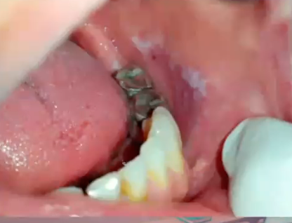 <p>what is the cause of this lesion </p>