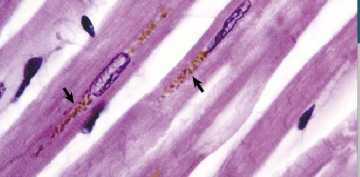 <p>What is this pigment accumulating in aged post-mitotic cells and describe what it is and 2 pathological causes</p>