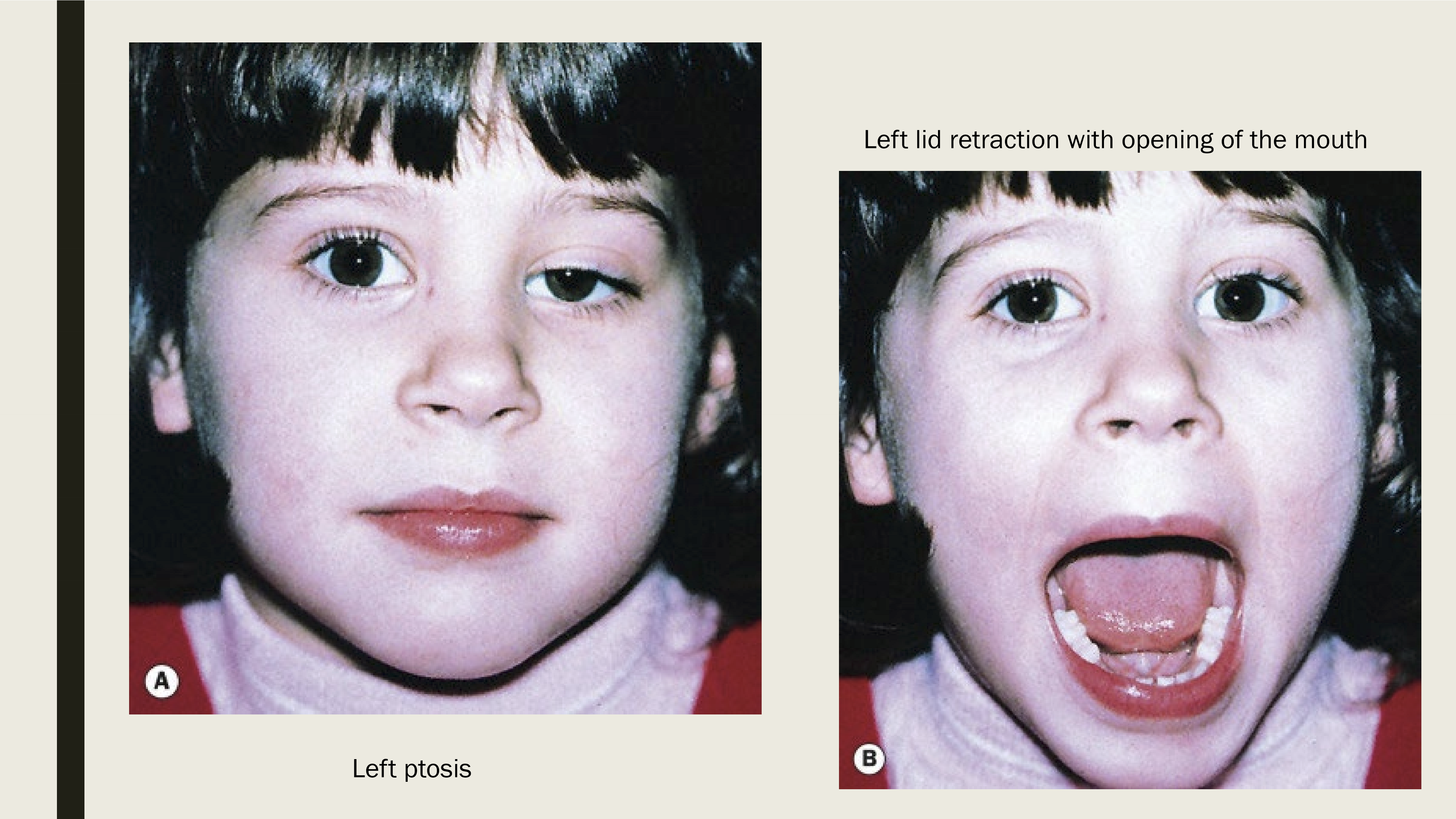 <p>Seen at birth, typically unilateral</p>