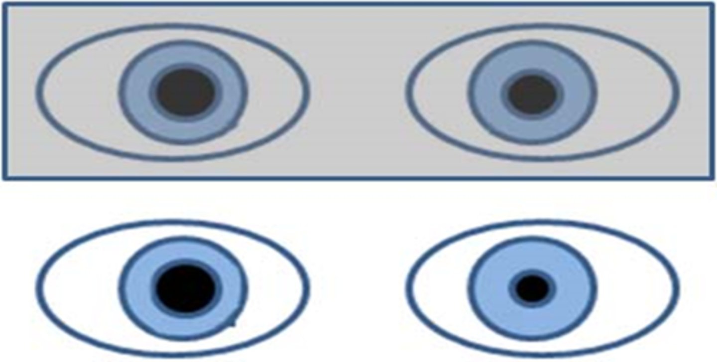 <p>iris cannot constrict = parasympathetic issue</p><p>ex) internal ophthalmoplegia</p>