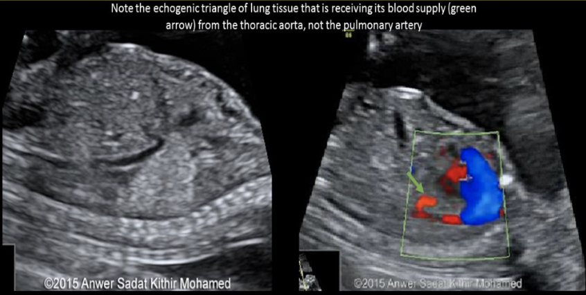 <p>how is <strong>pulmonary sequestration</strong> differentiated from other chest masses</p><p>a) the only hyperechoic fetal chest mass</p><p>b) the only hypoechoic fetal chest mass</p><p>c) use color doppler to confirm there is <strong><u>no blood supply</u></strong> to the mass</p><p>d) use color doppler to identify the feeding artery from the AO</p>