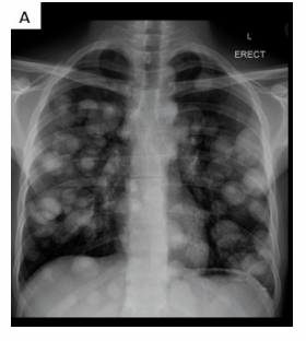 <p>-lung metastasis</p>