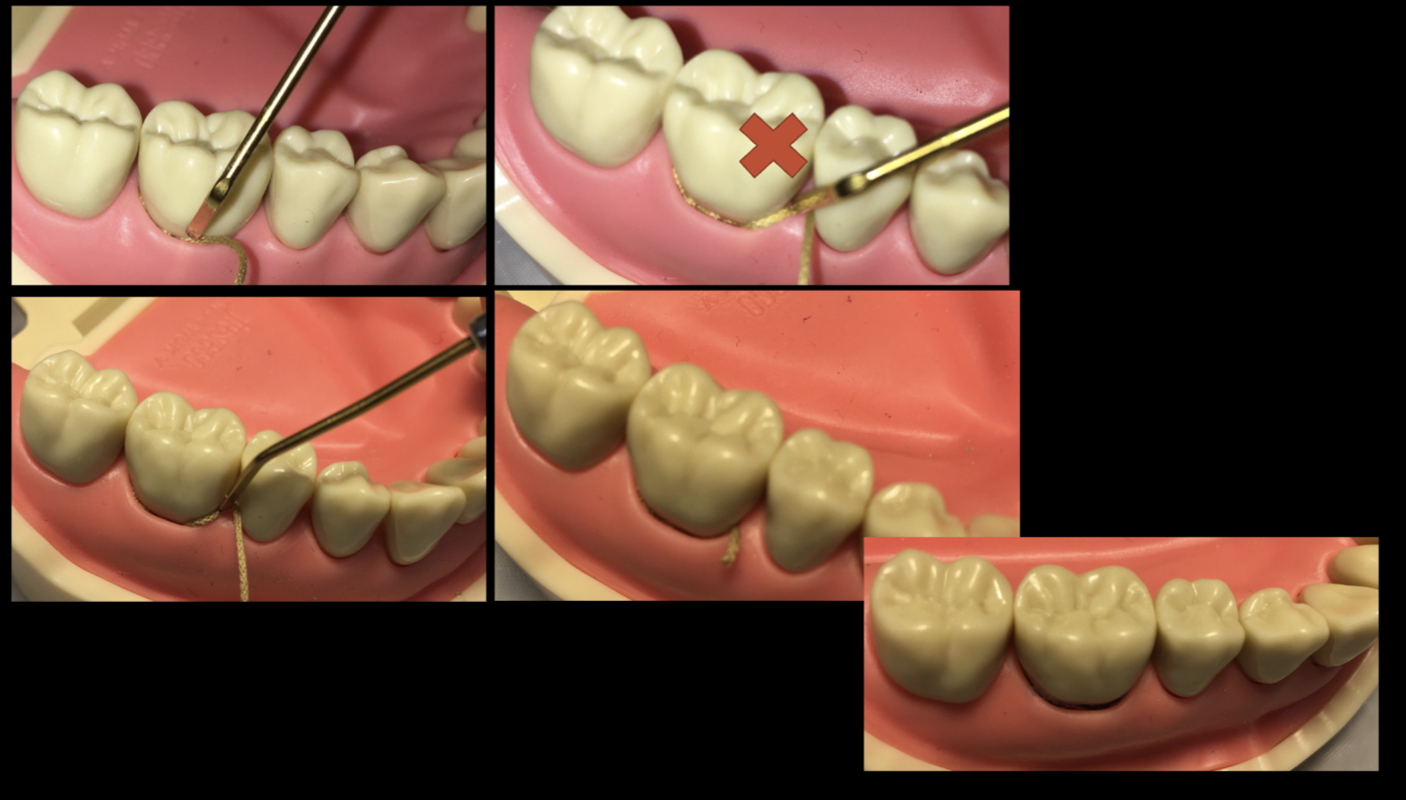 <ol><li><p>eval the health of gingiva and the depth of the sulcus to select the proper cord- single or double </p></li><li><p>soak the cord in astringent/hemostat, avoid axcess solution </p></li><li><p>loop cord around tooth, depending ont he preparation area; adjust length to cover <strong>mesial and distal </strong></p></li><li><p>repeat process for a second cord if needed </p></li><li><p>when time to remove- wet cord w water so it won’t grab and tear the tissues when removed and create more bleeding </p></li><li><p>after removal, you have about 30 sec until gingiva goes back, use this time to further subgingival finish if needed </p></li></ol><p></p>