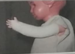 <p>Long Arm Circular Cast</p>
