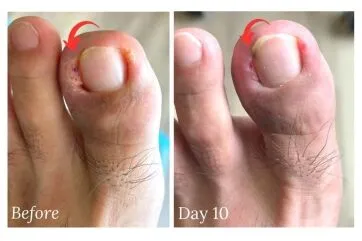 <p>complete or partial removal of a fingernail or toenail from its bed</p>