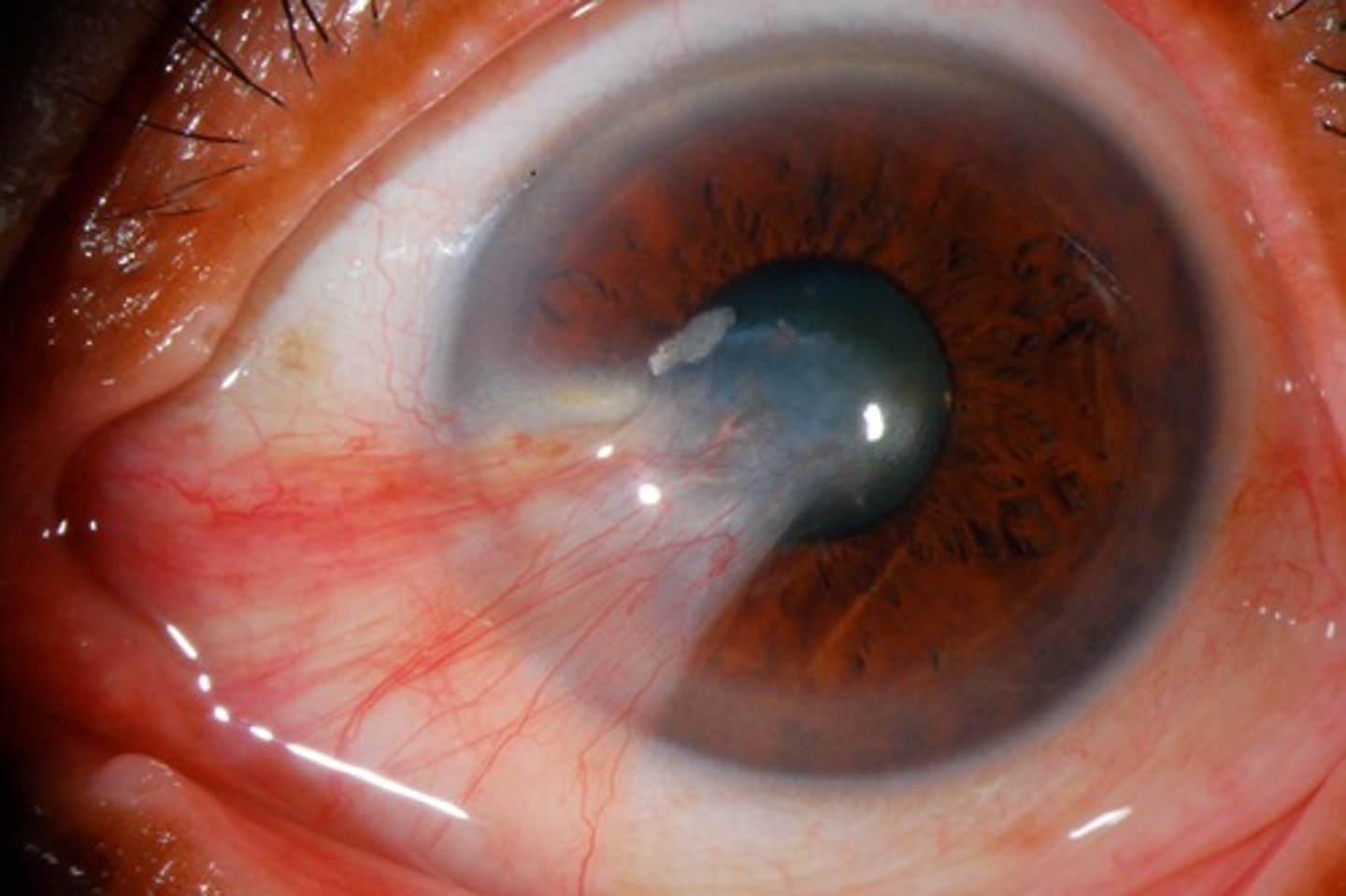 <p>Pterygium; occurs more commonly on the nasal side (common in people heavy exposed to ultraviolet light)</p>