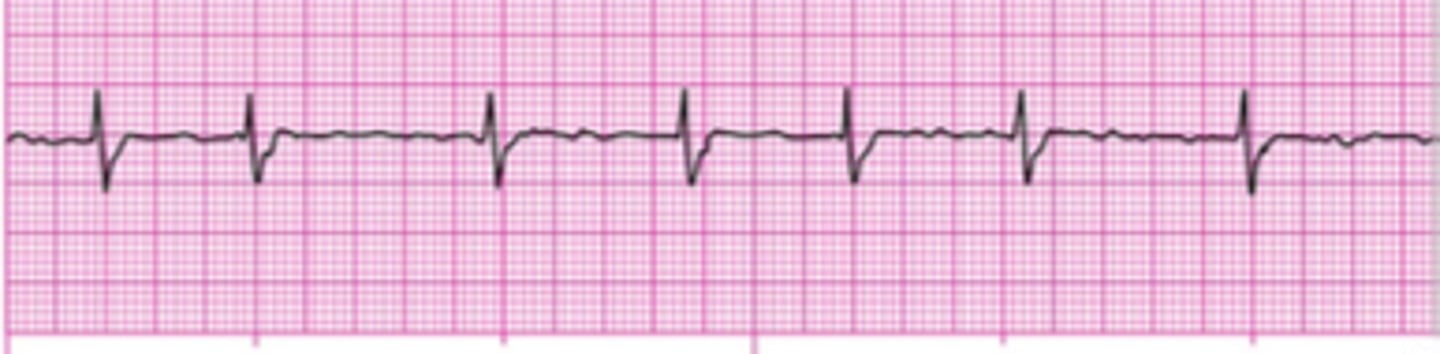 <p>- Atrial contraction are disorganized (quivering).</p><p>- No visible P wave</p><p>- Atrial rate ranges from 350-700 bpm</p><p>- Atria is clot</p><p>- Causes: hypoxemia, damage to SA node also seen in OSA.</p><p>- Treatment: digoxin, beta blockers, calcium channel blockers, anticoagulants and thrombolytics.</p>