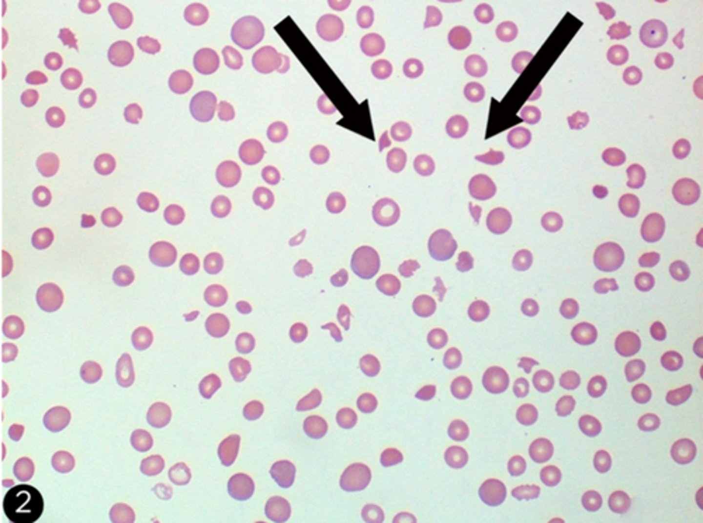 <p>-seen Disseminated intravascular coagulation with fragmented red blood cells (schistocytes) and thrombocytopenia</p><p>-Sclerderma renal crisis present with acute renal failture and malignant hpyertension. Peripheral blood smear can show microangiopathic hymolytic anemia with schistocytes and thrombocytopenia</p>