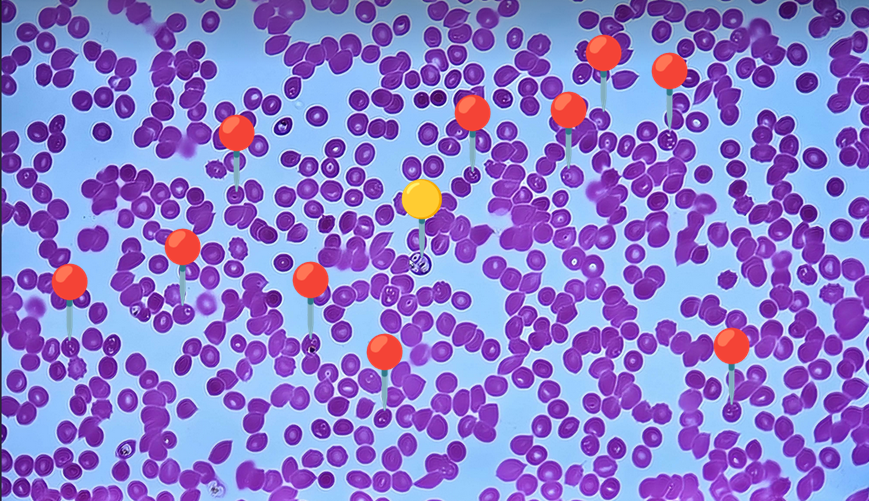 <p><span data-name="drop_of_blood" data-type="emoji">🩸</span><span data-name="microbe" data-type="emoji">🦠</span><span><span> </span></span><strong><em>Plasmodium falciparum </em></strong><sub>(Postać pierścienia)</sub></p><p></p><p></p><p><span>🔴 - stadium pierścienia;</span></p><p></p><p><span>🟡 - ciekawostka: potrójne zarażenie.</span></p><p></p><p></p><p><span>😷❓ </span><strong>Parazytoza:</strong><em> Malaria</em></p>