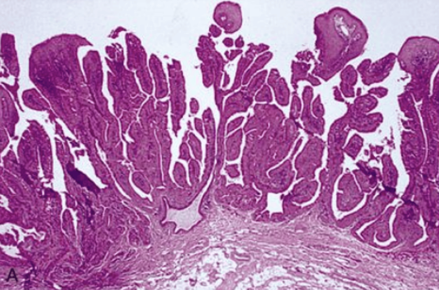 <p>These histologic characteristics are indicative of what oral pathology?</p><p>Papillary projections</p><p>Inflammation</p><p>Intraductal</p>